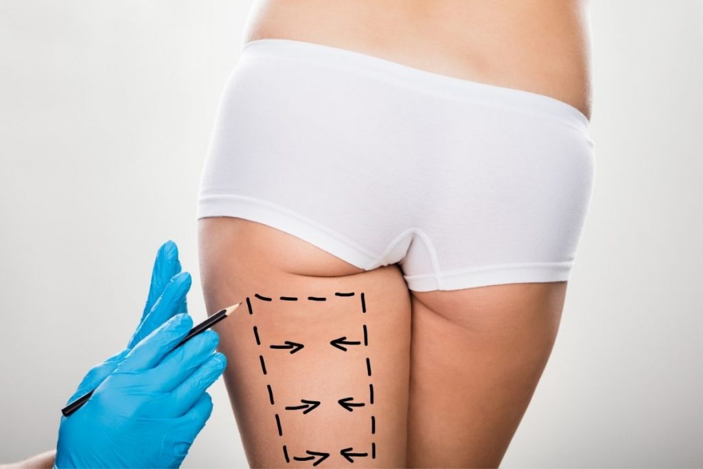 Chrirug w Klinice Genesis przygotowujący pacjentkę do zabiegu liposukcji